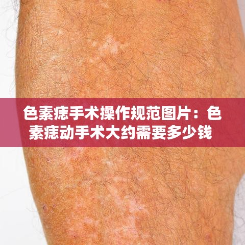 色素痣手術操作規(guī)范圖片：色素痣動手術大約需要多少錢 