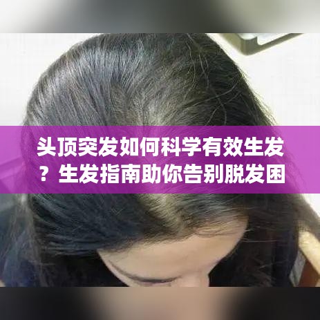頭頂突發(fā)如何科學(xué)有效生發(fā)？生發(fā)指南助你告別脫發(fā)困擾！