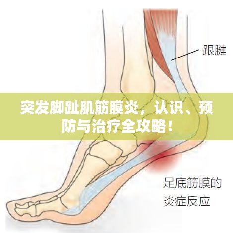 突發(fā)腳趾肌筋膜炎，認(rèn)識(shí)、預(yù)防與治療全攻略！
